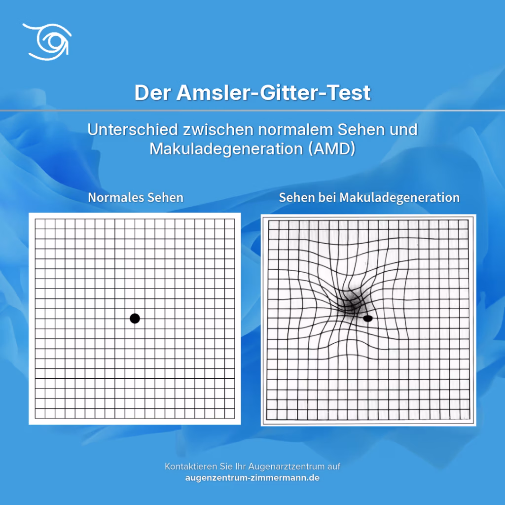Eine Darstellung des Amsler-Gitter-Tests. Auf der linken Seite mit normalem Sehen und rechts mit Makuladegeneration.