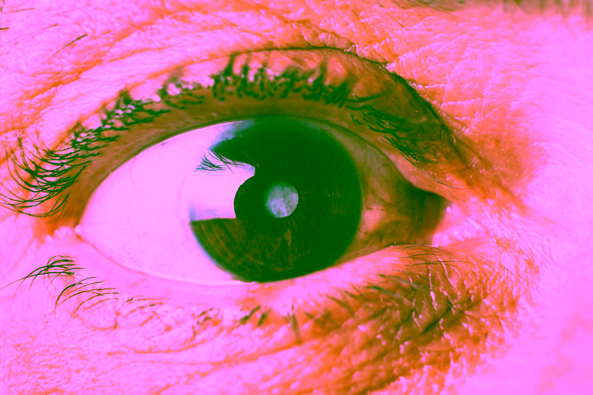 Eine Nahaufnahme von einem Auge mit Grauer Star (Katarakt).