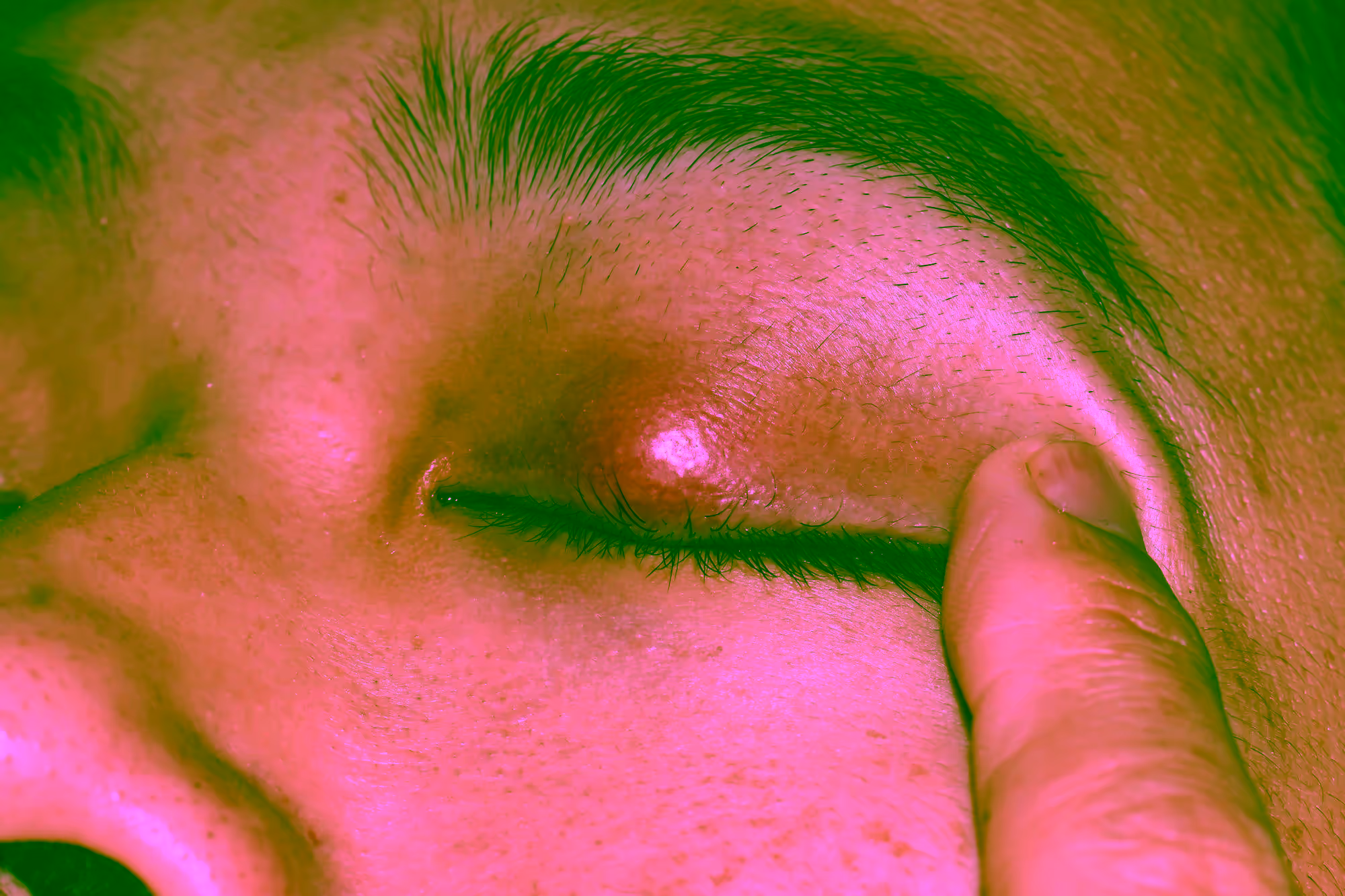 Ein entzündetes Auge mit einem Hagelkorn.