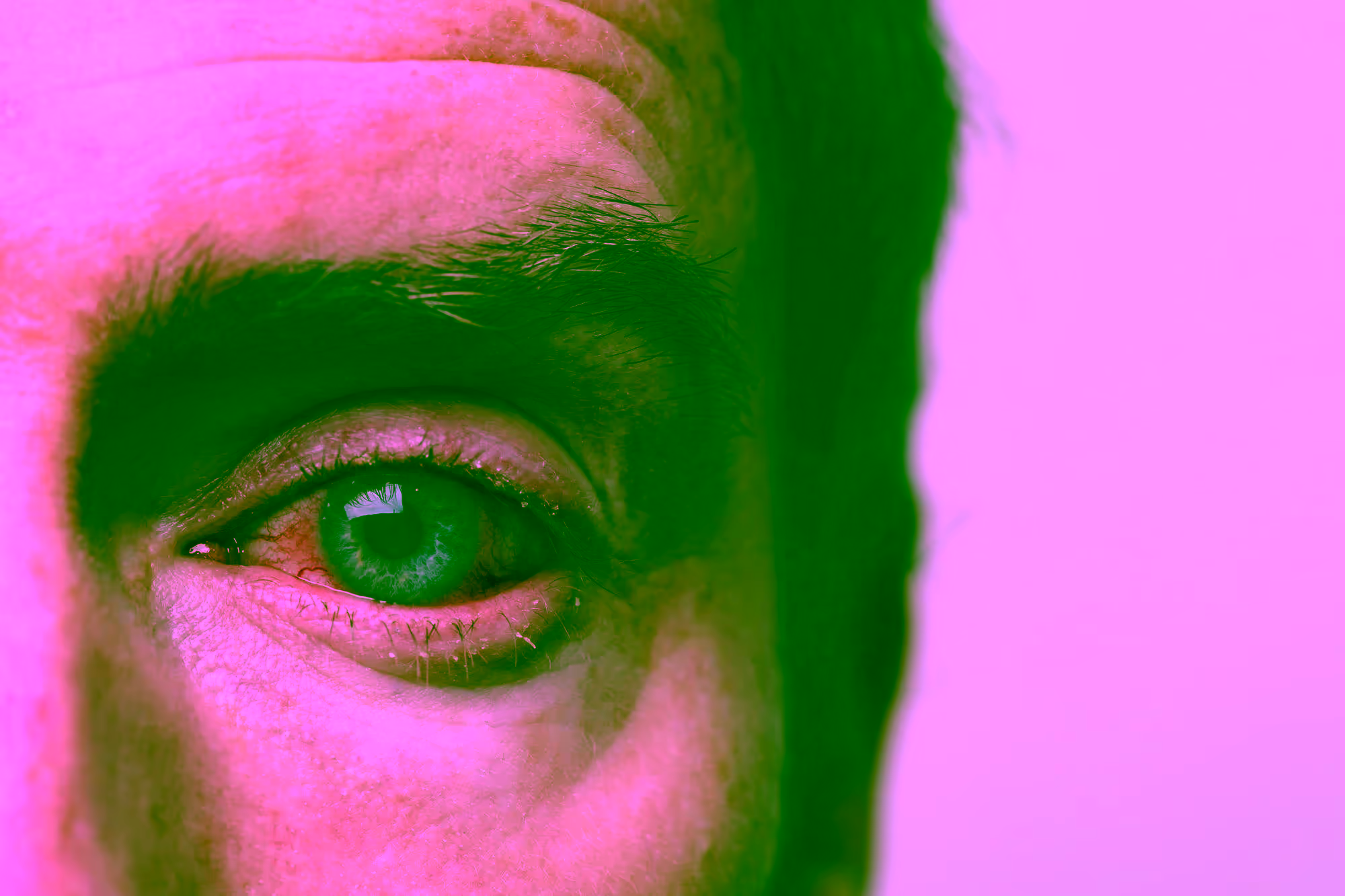 Ein Mann mit einer Lidrandentzündung (Blepharitis).